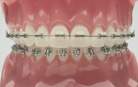 data-id="gnvjbetu46"> b>3m陶瓷自锁托槽 /b>又叫3m陶瓷自锁牙套或3m