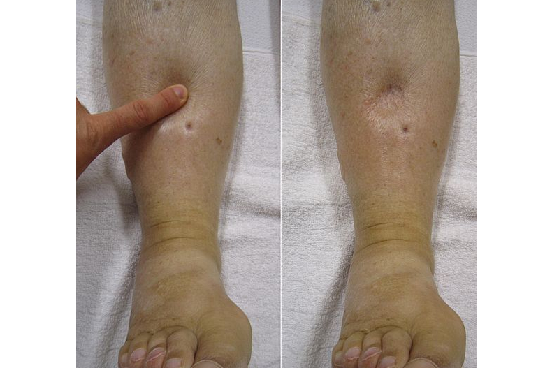  p>组织水肿是指组织间隙液体过多而引起的全身或身体的一部分肿胀的