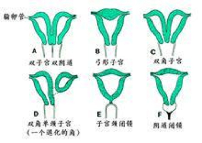 畸形子宫