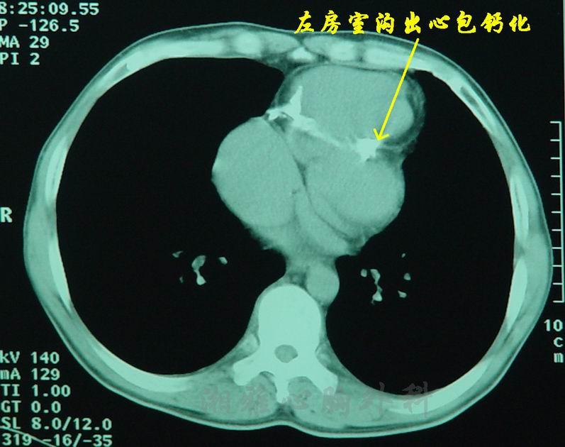  p data-id="gnayxat3mw">急性非特异性心包炎是一种浆液纤维蛋白性心