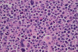 t淋巴母细胞性淋巴瘤