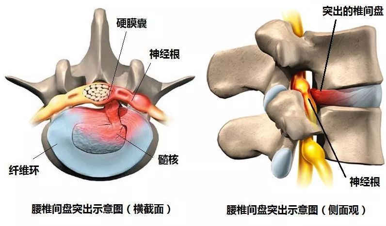 ">硬膜 /a>囊处在脊椎尾端所有神经汇聚的地方,是保护脊髓的一种组织