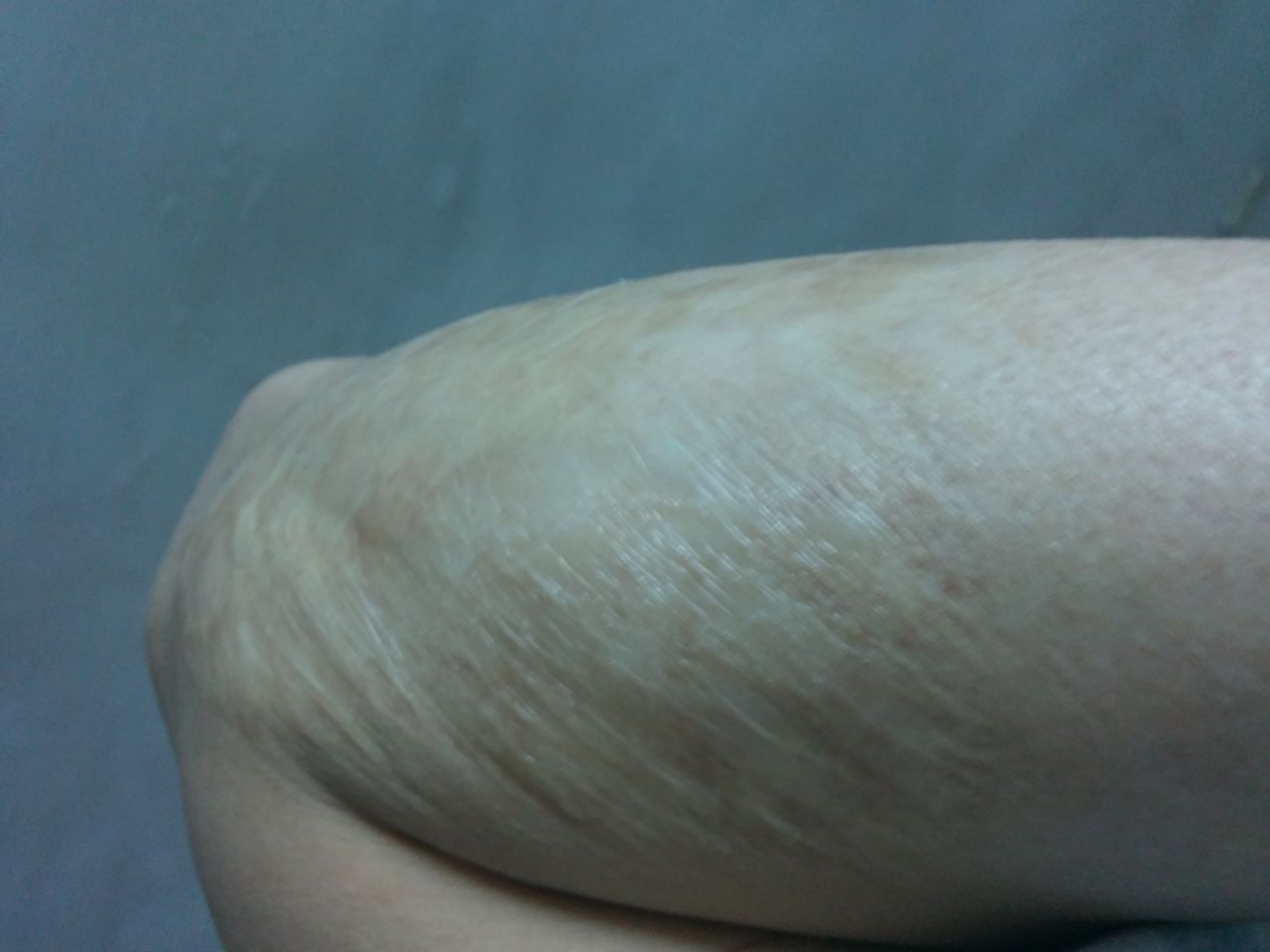  p> a href="#" data-lemmaid="7316289">疤痕 /a>是人体的皮肤组织