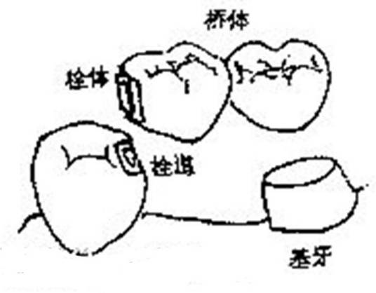 半固定桥_百度百科