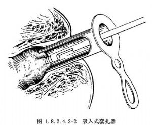 胶圈套扎法治疗内痔