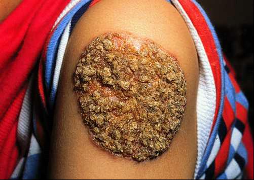  p>别称 /p> p>异菸肼又名 a target="_blank" href="/item/雷米封