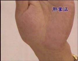 肝掌_百度百科