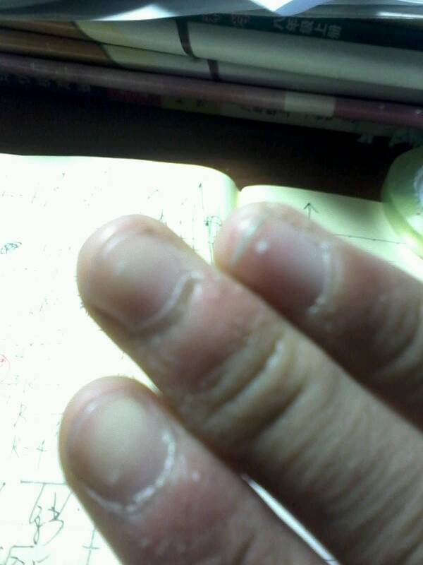 常见的有点状甲白斑病,线状甲白斑病,常发生于甲半月部,随着指甲生长