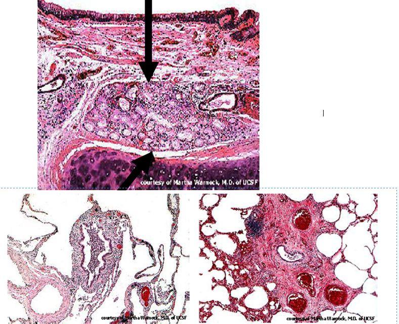 老年性慢性支气管炎
