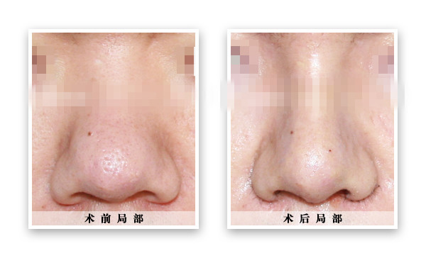  p>鼻头缩小术就是缩小 a href="#" data-lemmaid="3122">鼻子 /a>的