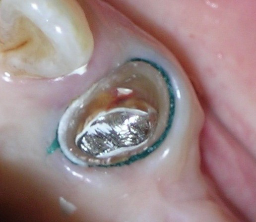  p>将排龈线放置于 a target="_blank" href="/item/牙龈/20258602"