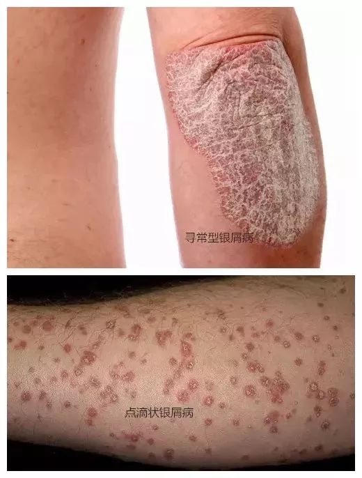 毛囊性寻常型牛皮癣的发病机制暂时不清,但其特点为患者成人多于儿童