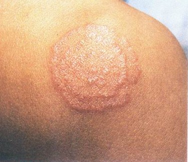  p data-id="gnx64r611x">铜钱癣也称钱币状皮炎,又称"金钱癣","铜钱