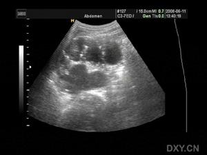 糖尿病性肾病变