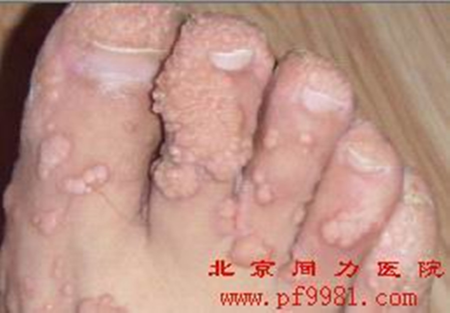  p>鱼痣即鱼鳞痣,究其本质不是一种痣,其实是一种 a target="_blank"