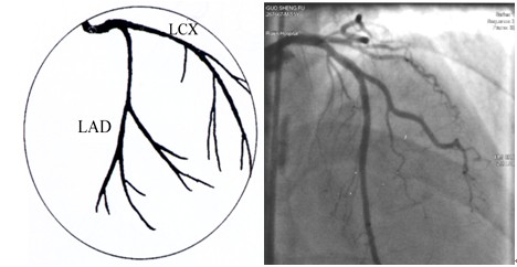 冠状动脉造影是诊断冠状动脉粥样硬化性心脏病(冠心病)的一种常用而且