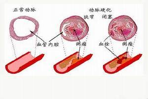 糖尿病肾脏病变