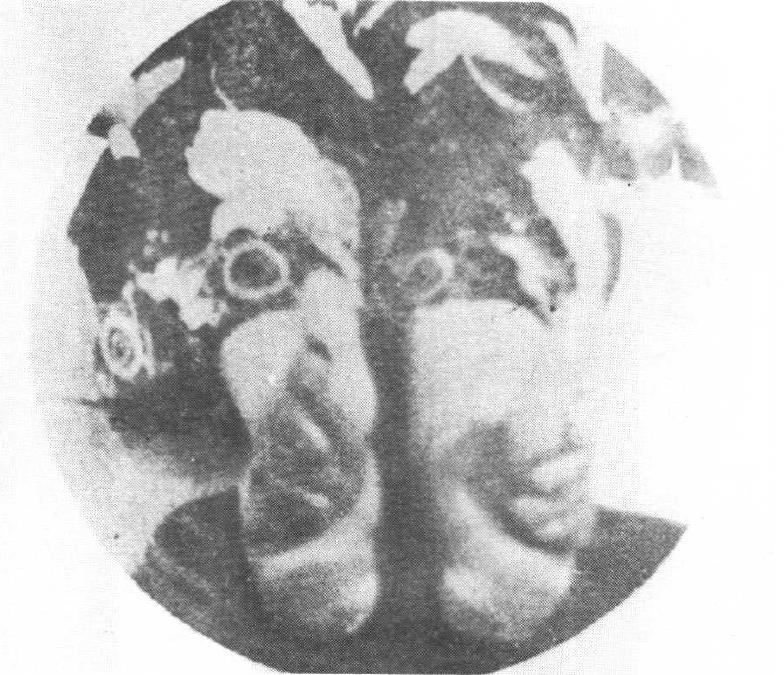  p>缠足是中国古代一种陋习.是用布将女性双脚紧紧缠裹,使之畸形变小.