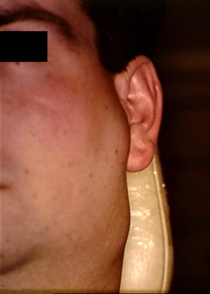  p>我国是鼻咽癌( a target="_blank" href="/item/肿瘤">肿瘤 /a>)