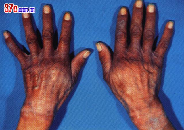 href="/item/尼克酸缺乏病">尼克酸缺乏病 /a>又叫烟酸缺乏病