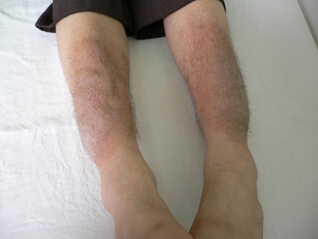 href="/item/水肿">水肿 /a>(myxedema),可分为全身黏液性水肿
