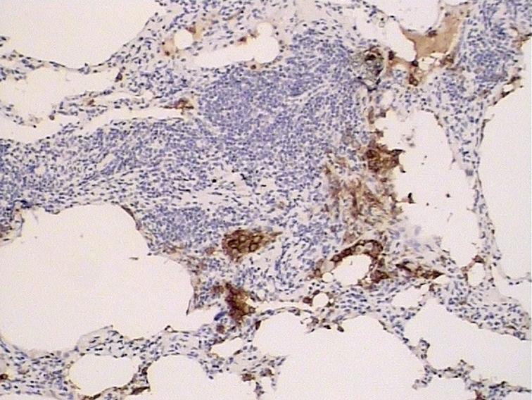 朗格汉斯细胞组织增生症