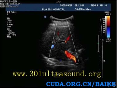  p>孤立肝坏死结节是一种少见的良性肝脏病变,于1983年由shepherd等