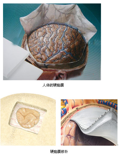  p>人工硬脑膜(artificial dura mater)是用生物材料制成人体脑膜的