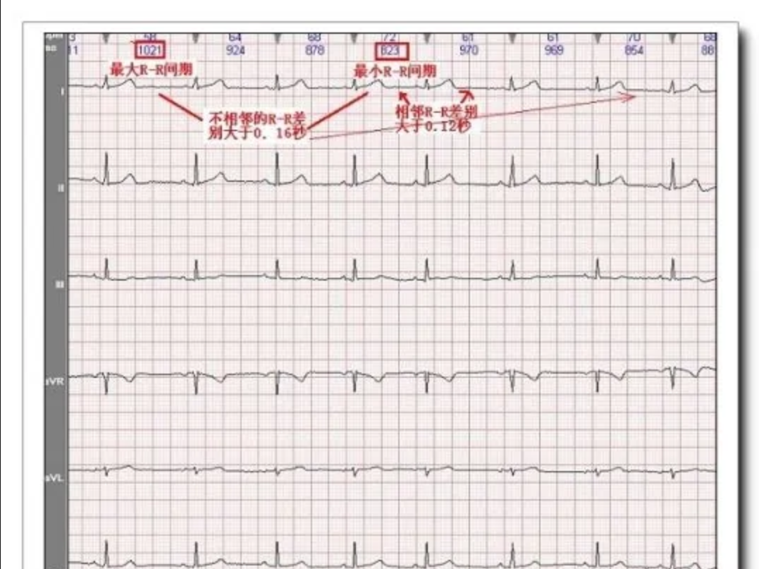  p>窦性心律过缓指如果心电图是窦性,低于60次/分为心律过缓,而正常的