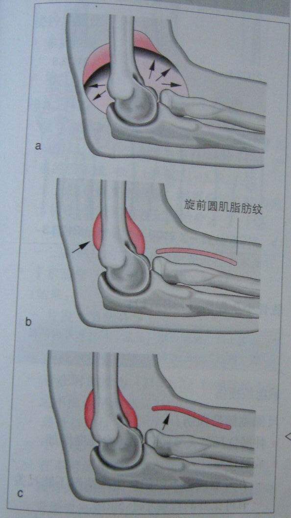 脂肪垫征