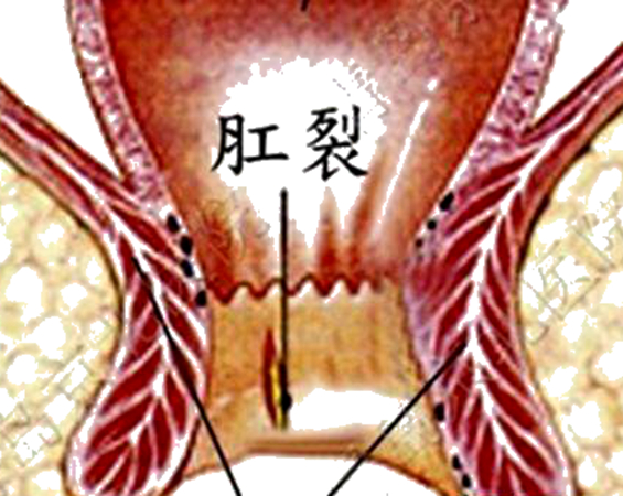 壮年,主要症状为排便时 a target="_blank" href="/item/肛门/402867"