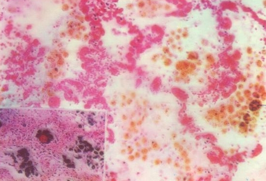 " data-lemmaid="8849994">肉眼 /a>就能看见一条条扩张的毛细血管