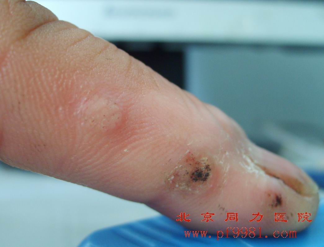  p>鱼痣即鱼鳞痣,究其本质不是一种痣,其实是一种 a target="_blank"