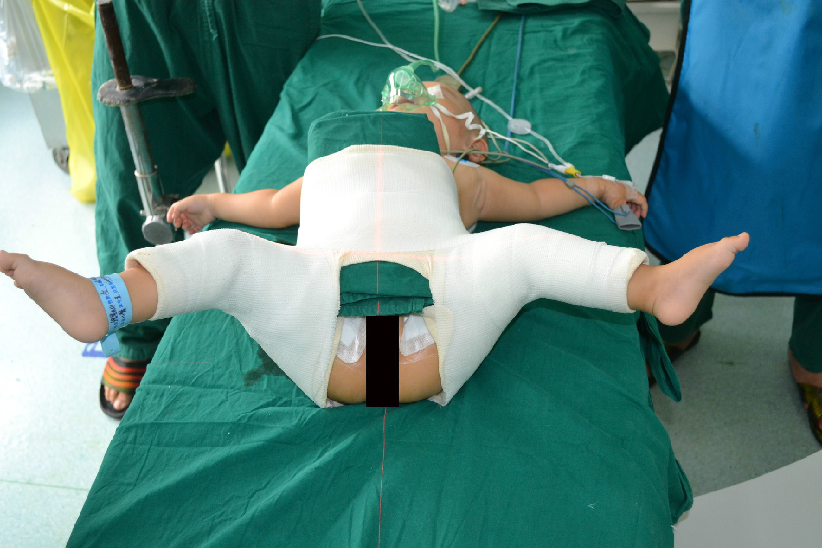 先天性髋关节脱位及髋发育不全