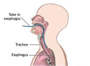 表现为仰颈时吞咽困难,屈颈时则消失