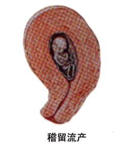 因此,皆规定胚胎停止发育后2个月尚未自然排出者,称为稽留流产.