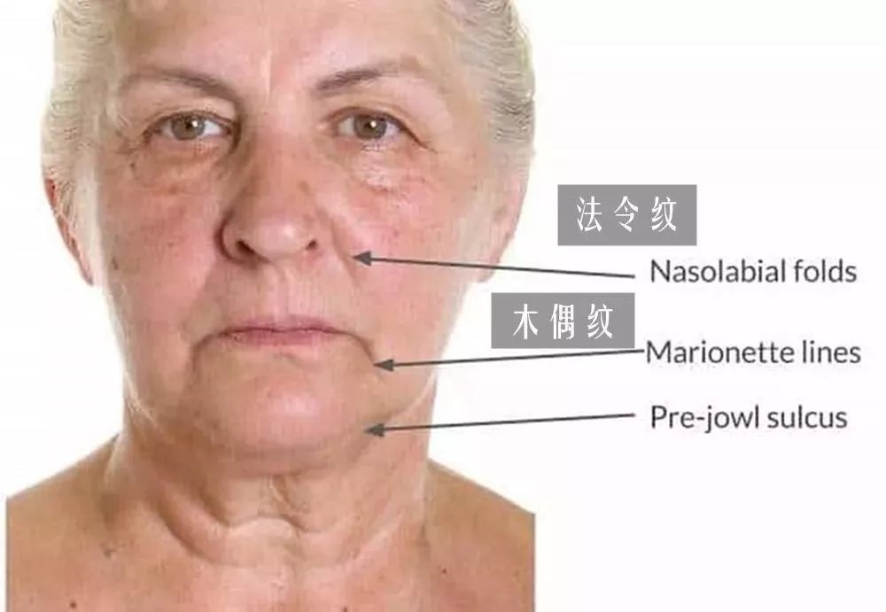 为什么有的人年纪轻轻就有法令纹？如何减弱法令纹？_百科TA说