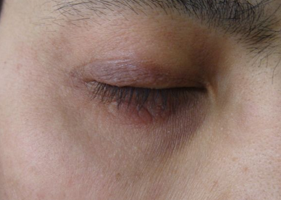 眼皮神经性皮炎