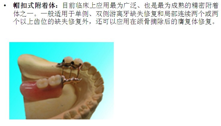  p data-id="gnwzalesxh">游离龈是指牙龈边缘不与牙面附着的部分