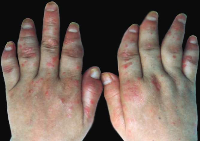 arthritis)是一种血清阴性(即血清类风湿因子阴性)的关节炎,典型地
