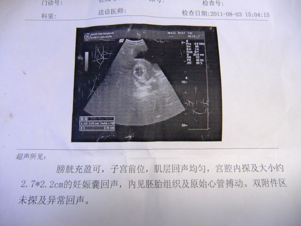 孕囊回声