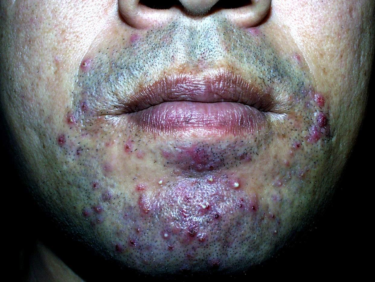 颌面部蜂窝织炎