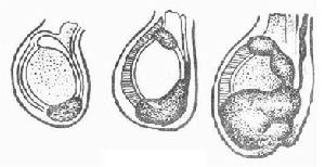  p>附睾 a target="_blank" href="/item/结核">结核 /a>