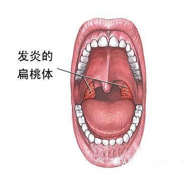 扁桃腺炎