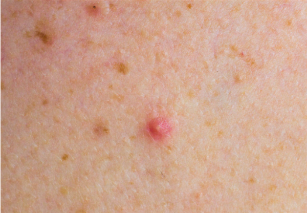 丘疹性痤疮