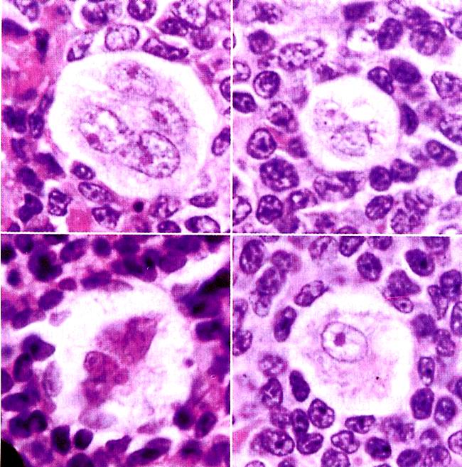 细胞见于hodgkins lymphoma( a target="_blank" href="/item/霍奇金