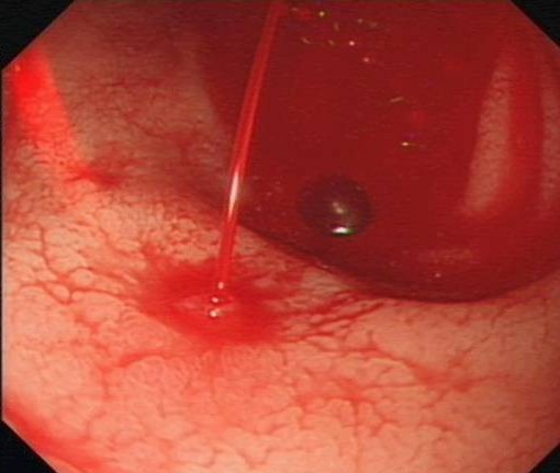  p>dieulafoy胃黏膜糜烂(dieulafoys disease)又称dieulafoy病变