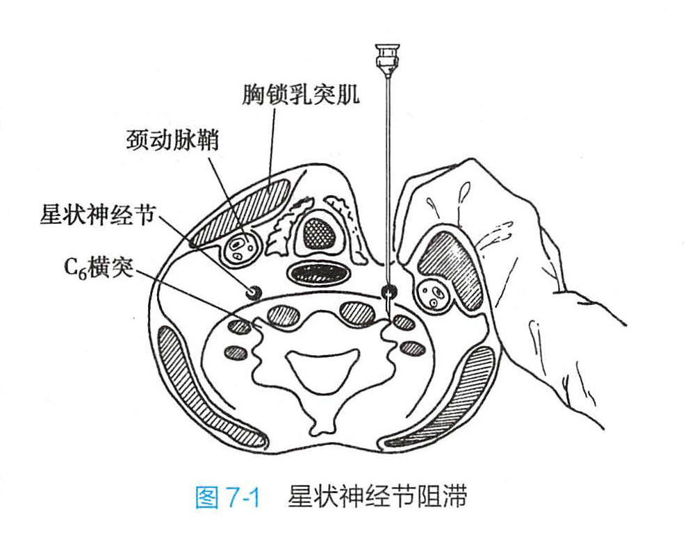 星状神经节阻滞