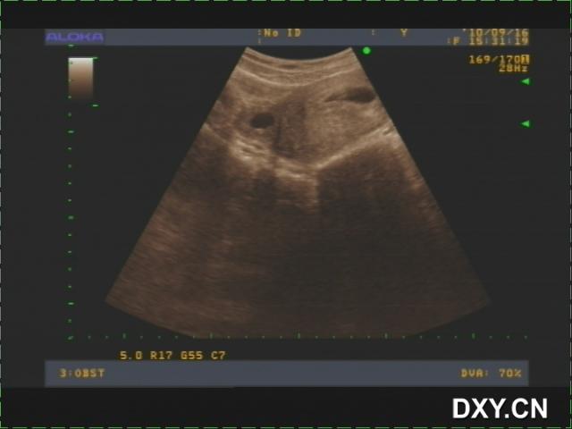 corpus luteum of pregnancy