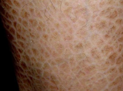 nigricans,x-连锁隐性遗传鱼鳞病(recessive x-linked ichthyosis)
